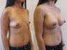 Breast Implants