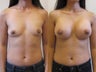 Breast Implants
