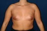 fat auto transplant from body to breast