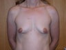 Breast Lift with Implants