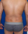 Laser Liposuction