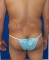 Laser Liposuction