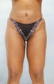 Liposuction
