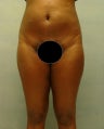 Liposuction