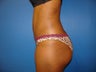 Mini Tummy Tuck