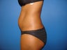 Mini Tummy Tuck