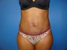 Abdominoplasty (Tummy Tuck)