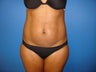 Abdominoplasty (Tummy Tuck)