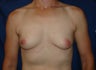 Breast Reconstruction 