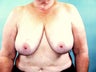 Breast Reconstruction