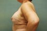 Breast Reconstruction