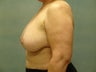 Breast Reconstruction