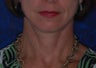 Facelift