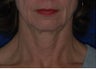 Facelift