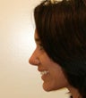 rhinoplasty
