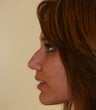 rhinoplasty