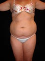 Liposuction of the trunk