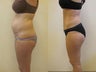 Tummy Tuck