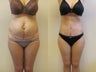 Tummy Tuck