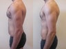 Gynecomastia