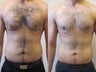 Gynecomastia
