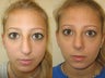 Rhinoplasty