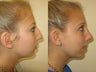 Rhinoplasty