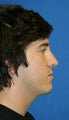 Rhinoplasty