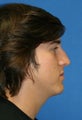 Rhinoplasty
