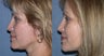 Rhinoplasty