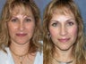 Rhinoplasty