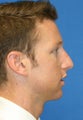 Rhinoplasty