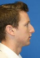 Rhinoplasty