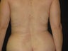 liposuction