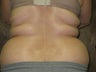 liposuction