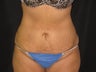 Liposuction