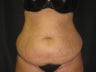 Liposuction