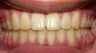 Teen Orthodontic Treatment 