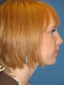 Rhinoplasty