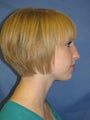 Rhinoplasty