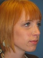Rhinoplasty