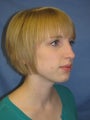 Rhinoplasty