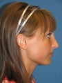 Rhinoplasty