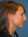 Rhinoplasty