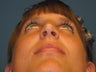 Rhinoplasty