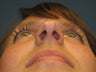 Rhinoplasty