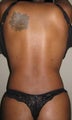 Liposuction Back & Waist