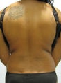 Liposuction Back & Waist
