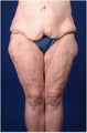 Lower Body Lift after Massive Weight Loss (Gastric Bypass)