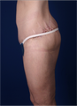 Lower Body Lift after Massive Weight Loss (Gastric Bypass)